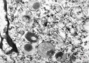 myelinoid inclusion in an unclassified tumor - peroxisomes? myelinoid inclusion in an unclassified tumor - peroxisomes?